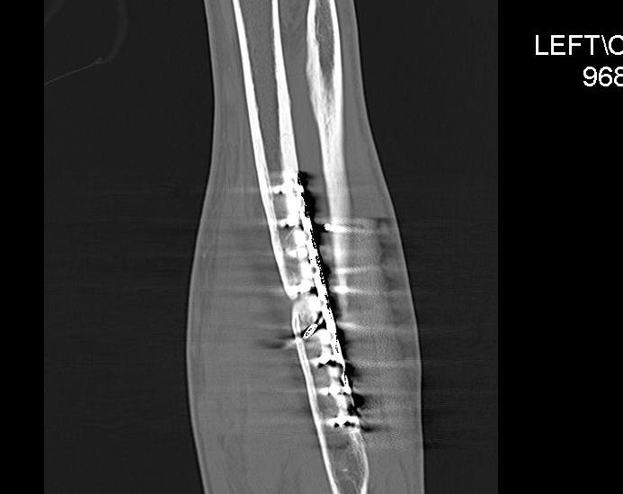 Radial Fracture Non Union CT